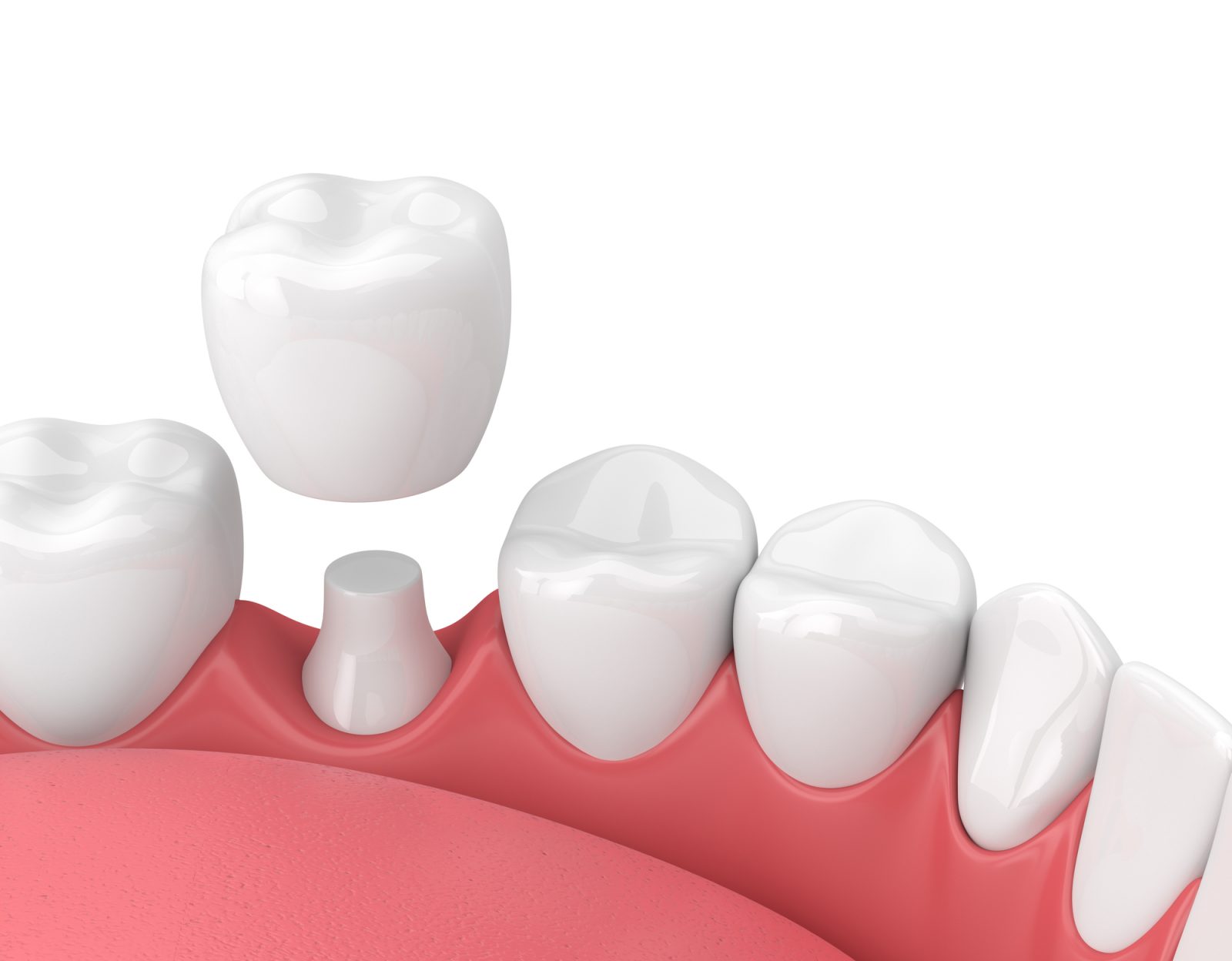 Implant dentaire : comment expliquer sa mise en place ?